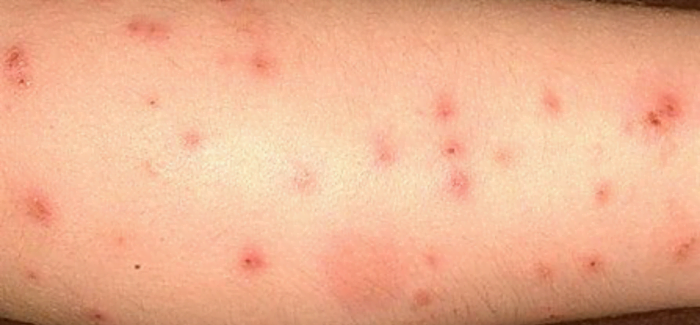 Flea Bites vs. Bed Bug Bites: Symptoms and Differences ...