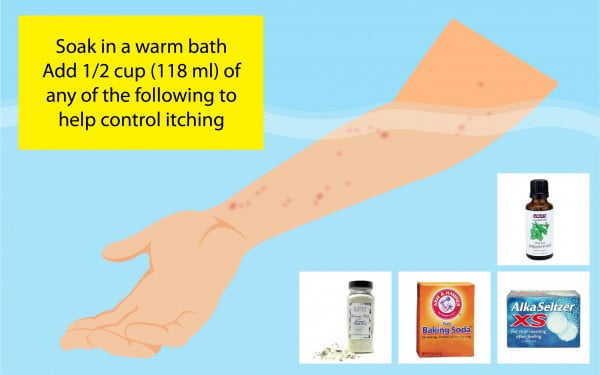 How to treat the bites of bed bugs