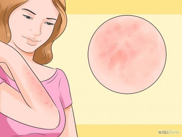 The ammonia bed bugs bites